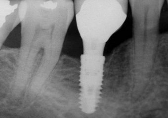 Implantati kot odlični nadomestki zobe korenine