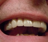 Zobne luske iz porcelana odražajo lastnosti naravnih zob