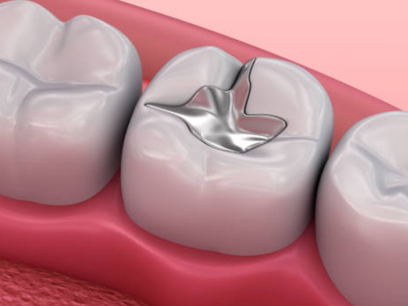 amalgamske zalivke za zobe