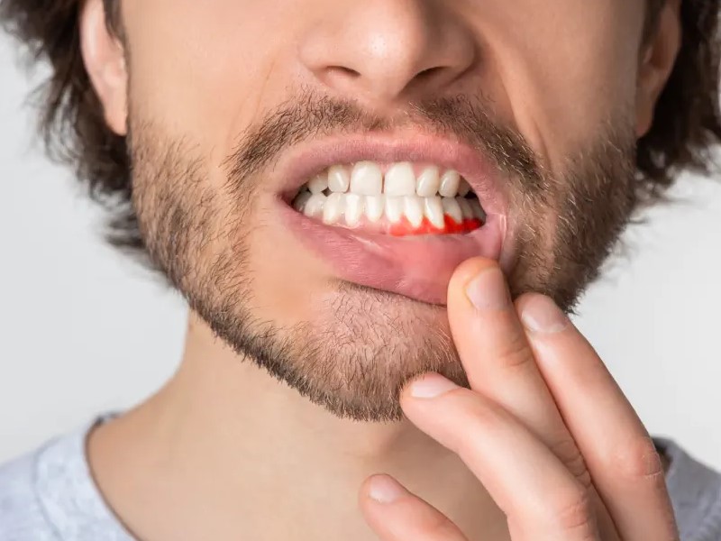 preprečite vnetje dlesni